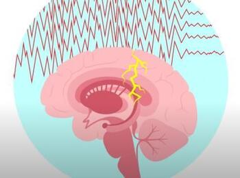 Un module d'information vidéo pour tout savoir sur les crises d'épilepsie